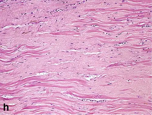 Replacement fibrosis in myocardial infarction, typically being boundless, dense and not conforming to the other types.