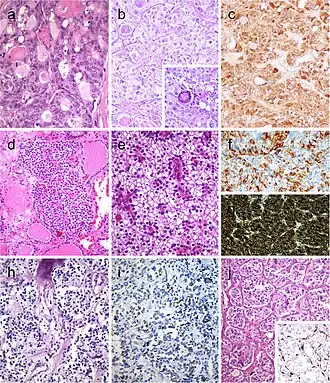 Follicular patterned medullary thyroid carcinoma (MTC) (a). In this other follicular patterned MTC (b), there are several calcifications simulating psammoma bodies (inset) and positivity for calcitonin (c). Intrathyroidal parathyroid tissue (d). The microscopic aspect of an intrathyroidal parathyroid adenoma is similar to eutopic parathyroid adenomas (e). Intrathyroidal parathyroid adenoma expressing chromogranin A (f) and PTH (g). Calcitonin-negative medullary thyroid carcinoma (h) showing positivity for CGRP (i). Paraganglioma (j) typically shows negativity for calcitonin and S100-positive sustentacular cells (inset)
