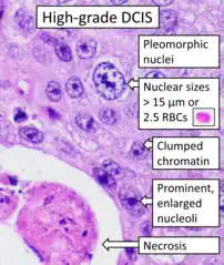 Histopathology of high-grade DCIS. H&E stain. RBC = red blood cell.[27]