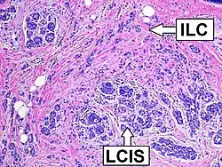 Histopathology of invasive lobular carcinoma (ILC), next to lobular carcinoma in situ (LCIS)