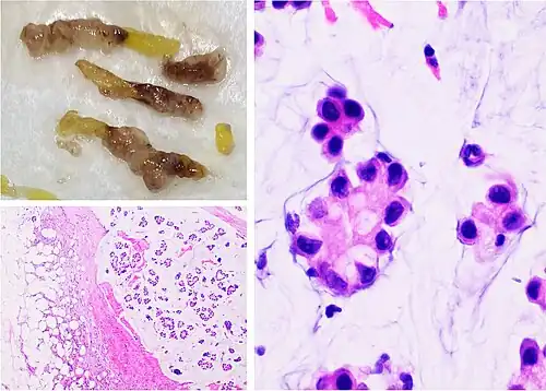 Mucinous carcinoma of the breast: Gross pathology (upper left) of mucinous carcinoma shows gelatinous areas. Histopathology shows clusters or nests of tumor cells floating in pools of extracellular mucin.