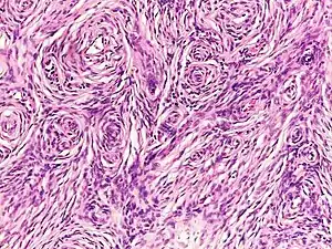 Histopathology of neurofibroma: A spindle cell lesion composed of slender fibroblast-like cells with storiform pattern and very low amount of stroma.[16]