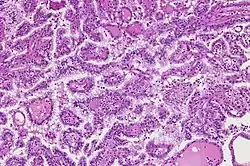 Gross appearance of Papillary renal cell carcinoma