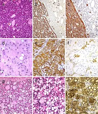 Tumor of the thyroid with solid cell nest features disclosing small cells of the main cell type (a) that express p63 (b) and cytokeratin 5 (c), in the absence of TTF1, calcitonin, and thyroglobulin expression. Hyalinizing trabecular tumor (d–f) is composed of trabeculae of elongated or polygonal cells admixed with abundant amounts of hyaline material negative for amyloid and positive for type IV collagen (f); Ki-67 is characteristically expressed in the cell membrane but not in the nuclei of the tumor cells (e). Follicular adenoma with signet ring cells (g and h), showing strong positivity for thyroglobulin (i)