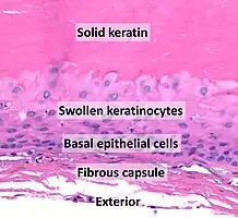 Histopathology of a trichilemmal cyst, from internal (top) to external (bottom):[10] - Solid eosinophilic-staining keratin. - Swollen pale keratinocytes, which increase in height closer to the interior. - Small, cuboidal, dark-staining basal epithelial cells in a palisade arrangement, with no distinct intercellular bridging. - Fibrous capsule. There is no granular cell layer (in contrast to an epidermoid cyst).