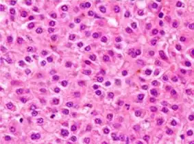 Well-differentiated HCC