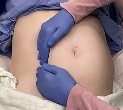Pulling the uterus off the inferior vena cava
