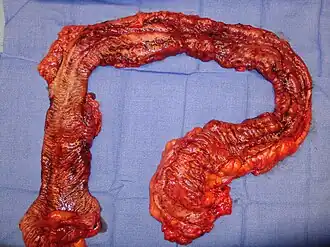 Colon resection