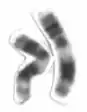 Chromosome 11 involved in causing the syndrome, due to extra genetic material.