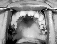 Notched incisors known as Hutchinson's teeth which are characteristic of congenital syphilis