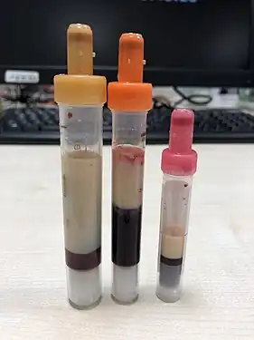 Blood samples of a young person with extreme hypertriglyceridemia