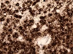 IDH1 R132H in anaplastic oligodendroglioma