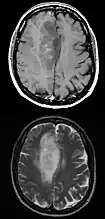 Axial post-contrast T1 (top) and T2 (bottom) weighted MRI showing an IDH1 mutant frontal lobe glioblastoma with sparse enhancement despite large size.