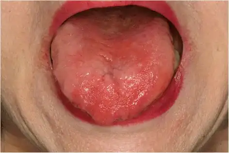 Possible sign of B12 deficiency: redness and depapillation of the tongue.[23]