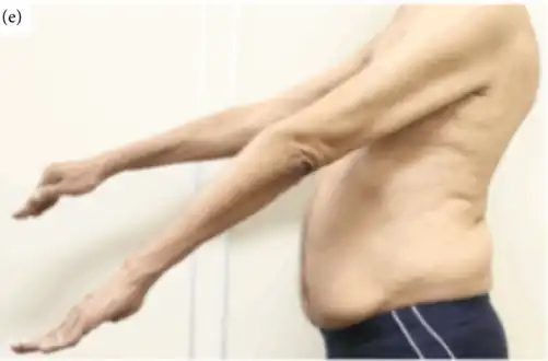 Affected arms and fingers in IBM