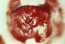 HSV cervicitis