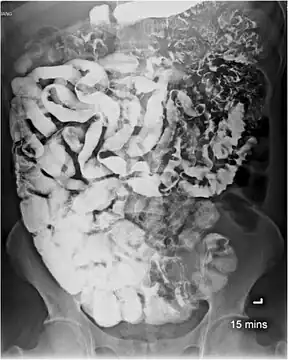 Small bowel study in intestinal capillariasis showing continuous long segment of fold thickening, fold effacement, and increased luminal fluid.[4]