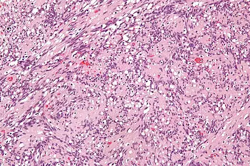 High mag. Intranodal palisaded myofibroblastoma
