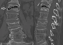 The intravertebral vacuum cleft sign (white arrow) is a sign of avascular necrosis. (Avascular necrosis of a vertebral body after a vertebral compression fracture is called Kümmel's disease.[13])