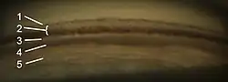 Gonioscopy of the anterior chamber angle. Labeled structures: 1. Schwalbe's line, 2. Trabecular meshwork (TM), 3. Scleral spur, 4. Ciliary body, 5. Iris