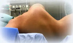 Kyphoscoliosis of the back in EDS.