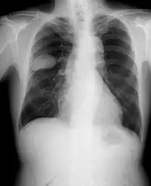 Frontal chest X-ray showing a probable S2–S3 small cell carcinoma in the right side lung.