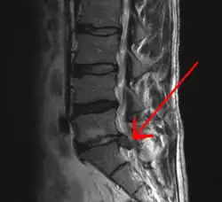 A herniated disc as seen on MRI, one possible cause of low back pain