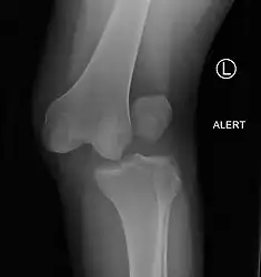 A lateral dislocation of the knee