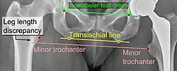 Leg length discrepancy after hip replacement is calculated as the vertical distance between the middle of the minor trochanters, using the acetabular tear drops or the transischial line as references for the horizontal plane. A discrepancy of up to 1&nbsp;cm is generally tolerated.
