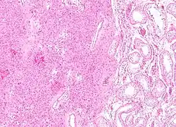 Low magnification micrograph of a Leydig cell tumour. H&E stain.