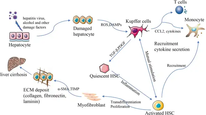 Pathogenesis of liver cirrhosis[28]