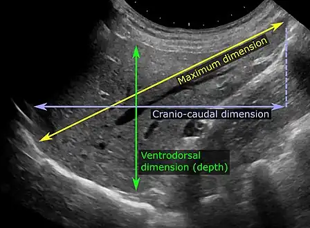 Abdominal ultrasonography of the liver, as a sagittal plane through the midclavicular line, with some standard measurements.[2]