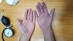 Self-induced hypoxia on the right hand (right side of the picture) versus a normal left hand (left side of the picture). The cyanosis was achieved by inflating and tightening a blood pressure cuff.