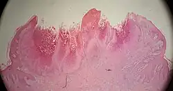 Low magnification micrograph of a molluscum contagiosum lesion