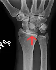 Dislocated lunate