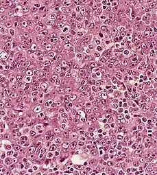 Undifferentiated nasopharyngeal carcinoma—high power[[