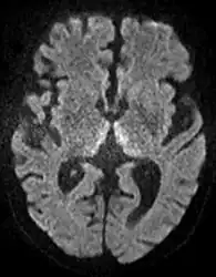 Axial MRI B=1000 DWI image showing hyperintense signal indicative of restricted diffusion in the mesial dorsal thalami.
