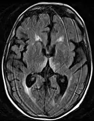 Axial MRI FLAIR image showing hyperintense signal in the mesial dorsal thalami, a common finding in Wernicke encephalopathy. This patient was nearly in coma when IV thiamine was started, he responded moderately well but was left with some Korsakoff type deficits.