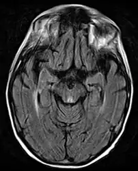 Axial MRI FLAIR image showing hyperintense signal in the periaqueductal gray matter and tectum of the dorsal midbrain.
