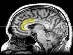 Sagittal MRI slice with highlighting indicating location of the anterior cingulate cortex.