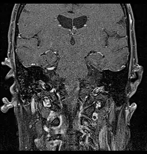Coronal MRI showing right parotid adenoid cystic carcinoma with perineural spread of tumor along the facial nerve extending to the stylomastoid foramen
