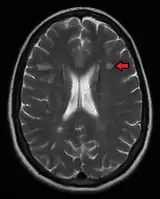 Multiple sclerosis as seen on MRI