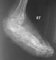X-ray foot: mycetoma