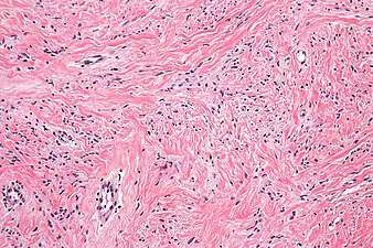High mag. Mammary myofibroblastoma
