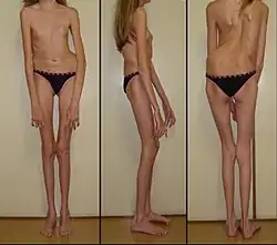 Long limbs with scoliosis