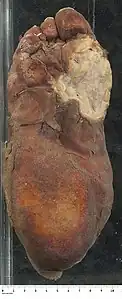 Museum specimen of Marjolin's' ulcer on the sole of a foot
