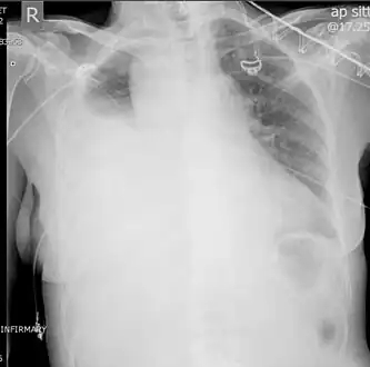 Right showing a massive right hemothorax