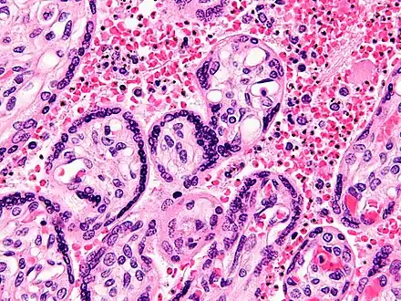 Micrograph of a placenta from a stillbirth due to maternal malaria. H&E stain. Red blood cells are anuclear; blue/black staining in bright red structures (red blood cells) indicate foreign nuclei from the parasites.