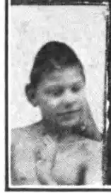 Trigonocephaly in a case of microcephaly