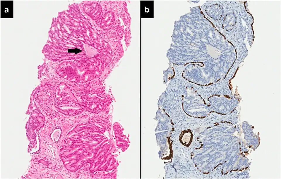 Intraductal carcinoma of the prostate with an infiltrative growth pattern may be morphologically difficult to distinguish from invasive cancer. One focus shows comedonecrosis (arrow), morphologically suggesting Gleason pattern 5 invasive carcinoma (a haematoxylin and eosin, b CK5/6)
